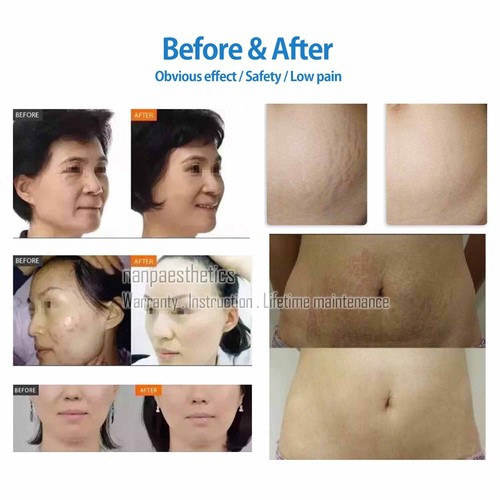 Professional Fractional Gold R-F Spa Beauty Machine Face Lift Face Body Beauty - Picture 9 of 10