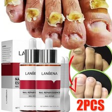 2x Fungal Nail Repair Essence Serum Nail File Hand Feet Treatment Nail Repair