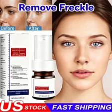 Effective Whitening Freckle Cream Remove Dark Spot Cream Removal Melanin Melasma