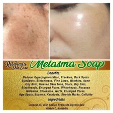 Whitening Melasma Soap Available Dark Sunspot Wrinkles Acne Blackheads Fine Line