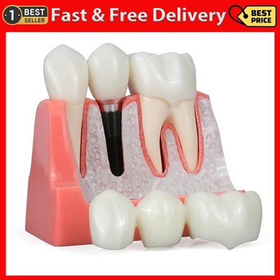 Dental Implant Model - 4 Times Removable Analysis Crown Bridge Demonstration ...