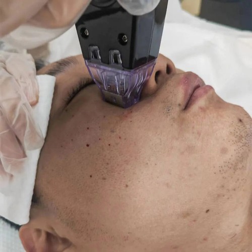 Macchina Rassodante Professionale M8 Oro Frazionato Radiofrequenza Pelle Lifting Viso - Foto 4 di 23