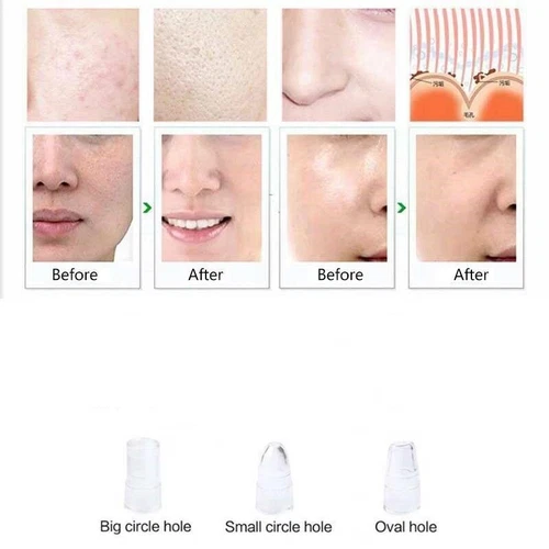 Skin Care Tips Head for Diamond Microdermabrasion Vacuum  Skin Facial Machine - Picture 5 of 10