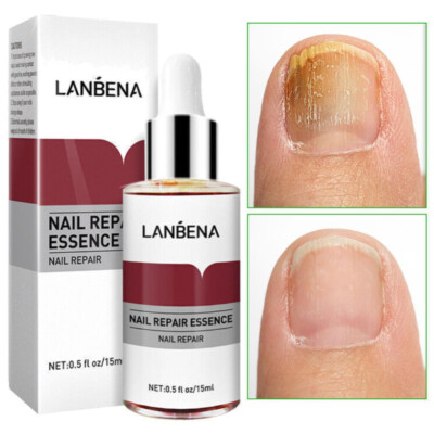 LANBENA Nail Repair Essence Oil Remove Onychomycosis Serum Fungal Nail Treatment