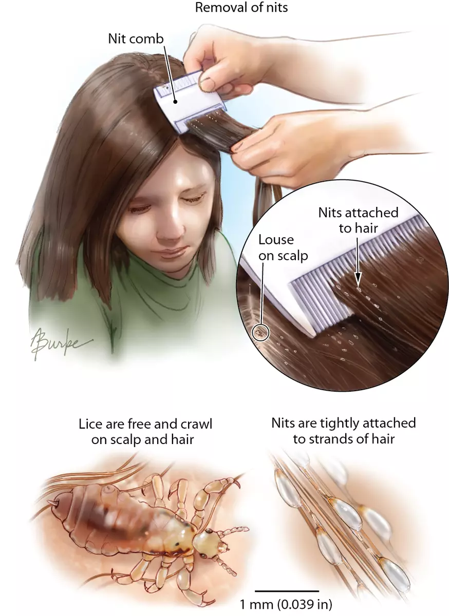 Lice eggs sale on comb