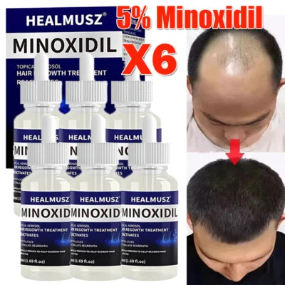 HEALMUS 6 Monats-Vorrat Extra Strength MINOXIDIL 5% Haarwachstum FÜR MÄNNER 6 x 50ML