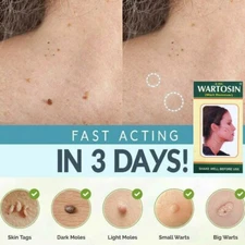 NEW SKIN TAG REMOVER CREAM SAFE FAST WART REMOVAL MOLE ACNE PIMPLE PATCH SPOT US