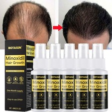 Minoxidil 5 Extra Strength for Men Fast Regrowth Anti Hair Loss Treatment Spray