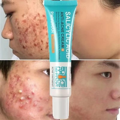 Salicylic Acid Acne Treatment Face Cream Repair Pimple Spots Deep Cleaning Pore