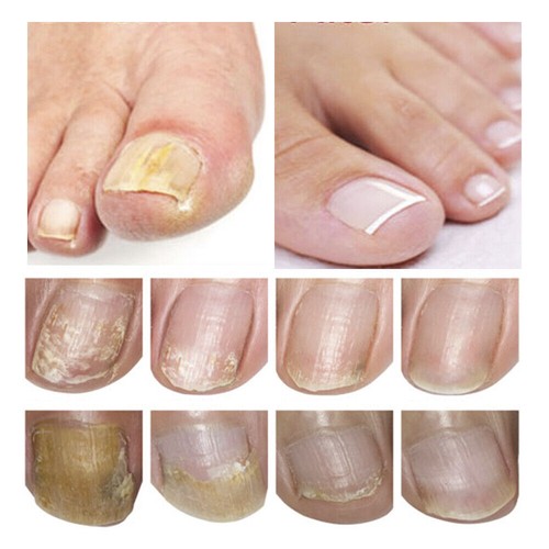 Nail Repair Serum Fungal Nail Treatment Liquid Remove Onychomycosis Toe Essence - Picture 5 of 16