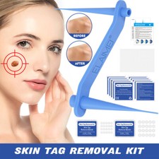 40x Rubber Rings Skin Tag Remover Tool Removal Skin Tag Mole  Wart Removal Tool