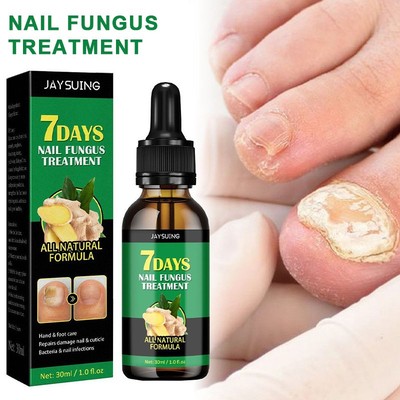 7 Days Nail Fungus Treatment All Natural Formula Gingers Nail Toenail Care 30ml