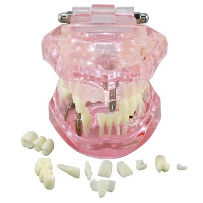 Dental Prosthetic Demonstration Model