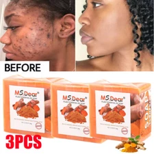 3pcs Tumeric Soap Skin Whitening Soap Acne Dark Spots Removal fit Facial & Body