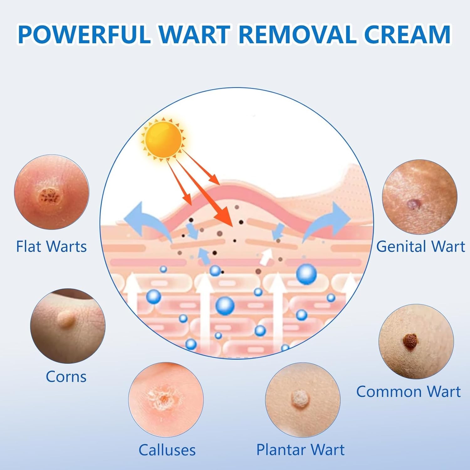 Wart Remover Fast Acting Gel Wart Remover Freeze,Genital Wart Freeze for Genital
