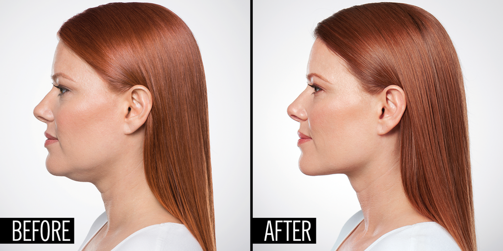 Reduce Double Chin by Chinese Herbs Powder Via Mask, See Change after 4 days