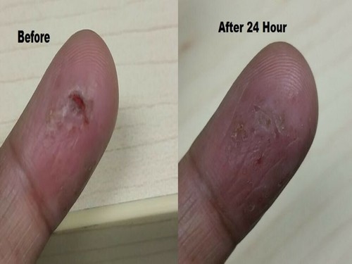 Contact dermatitis eczema cream non steroid - Picture 9 of 12