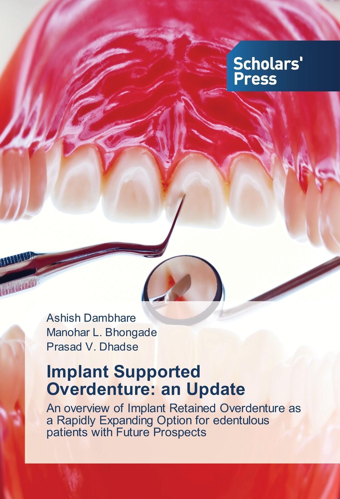 Thumbnail - Ashish Dambhare (u. A.) | Implant Supported Overdenture: An Update |