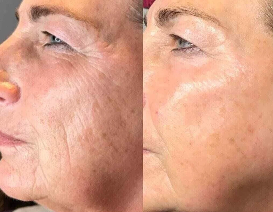 Matrixyl 3000, Argireline, Vitamin C Hyaluronic Acid Peptide Wrinkle SERUM - 4oz - Image 4 of 4