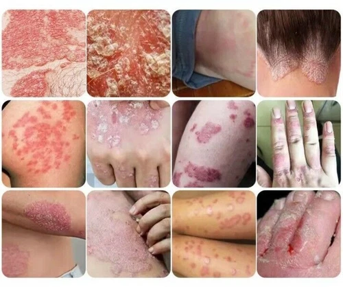 1x 20g Haut Psoriasis Creme Anti Dermatitis Ekzem Ekzem-Salbe Behandlung Creme-- - Bild 3 von 4