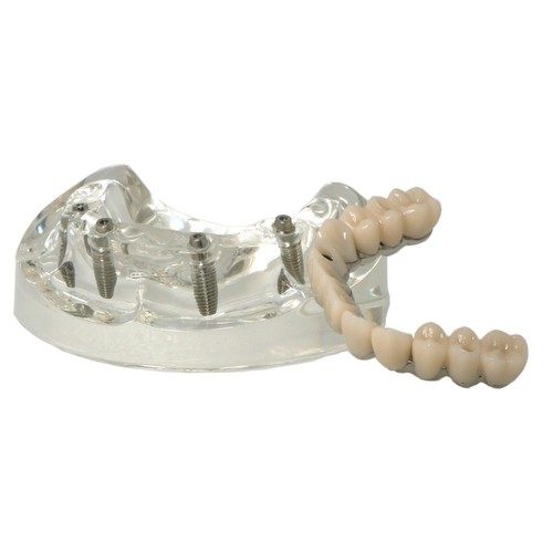 Dental Implant Model Upper All-on-4 overdenture 4 Screws titanium frame Clear - Picture 31 of 45