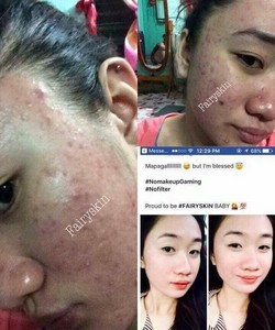 koreans with pimples