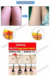 Best Cream Treatment For Sensitive Skin Razor Bumps No More