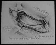 HUMAN SURGIAL PROCEDURE C1950 Magic Lantern Slide VINTAGE MEDICAL DIAGRAM