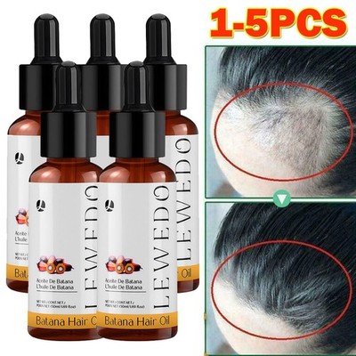 5/3x Batana Oil Serum For Hair Growth Healthier Thicker Fuller Anti Hair Loss