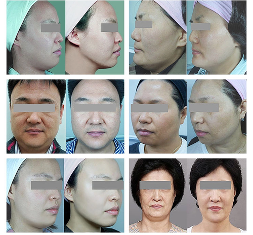 mini beauty salon equipment 2D 3D anti wrinkle facial skin lifting device 5 tips - Picture 7 of 7