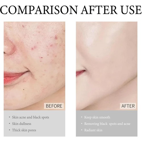 Pimple Cream for Face Gentle Face Cream Repair Pimple Spots Deep Cleaning Pore - Picture 7 of 12