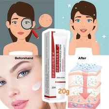 Powerful Spot-removing Whiten Cream Pigmentation Melasma Dark Spots