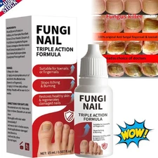 Fungi-Nail Anti-Fungal Liquid Solution Kills Fungus That Can Lead To Nail