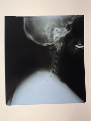 Vintage Xray Film, Medical Oddity, Skull-Skeleton-Spine-Bones, Exact Image 10x11