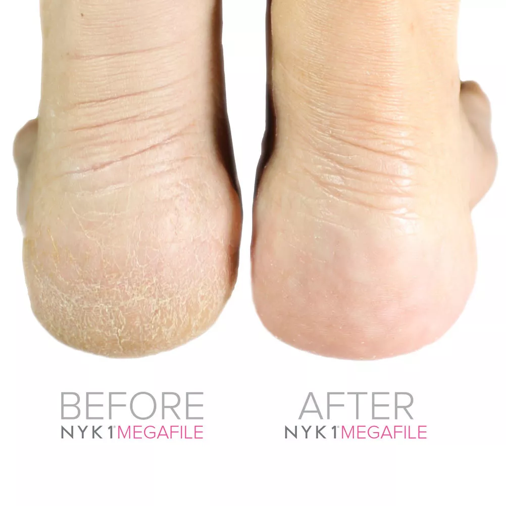 Megafile Foot File Rasp removes hard skin on feet, Callus Scraper Feet