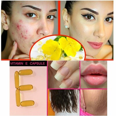 Vitamin E 400 mg Capsules For Face Hair Acne Nails EVION by MERCK 20 capsules