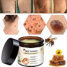 Bee Venom Treatment Repair Cream For Keratosis Pilaris Remove Warts Melanin Mole