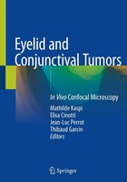 Mathilde Kaspi (U. A.) | Eyelid And Conjunctival Tumors | Taschenbuch | Englisch