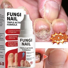 Fungi-Nail Anti-Fungal Liquid Solution Kills Fungus That Can Lead To Nail