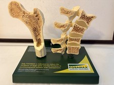 Fosamax Hip and Spine Cross Section Anatomical Pharmaceutical Model