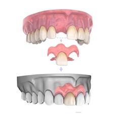 Partial Dentures for Women  Men, Custom Replacement Temporary Flipper Teeth ...
