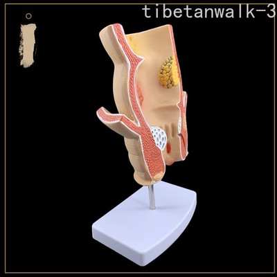Simulated Rectal Pathology Model Intestinal Specimens Human Anatomical Model