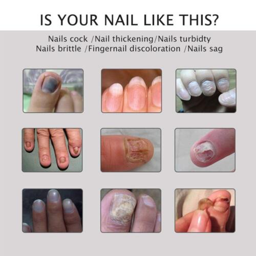 EFERO Nail Anti Fungal Infection Gel Treatment Hand Foot Cream Toenail Remove - Picture 4 of 14