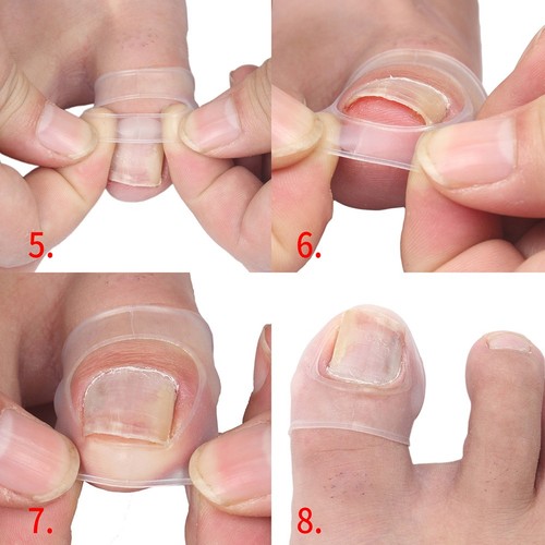 2pcs Silicone Ingrown Toenail Correcting Tool Pain Relief Paronychia Treatme BAK - Bild 16 von 21