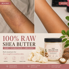 Natural Eczema Relief Cream Organic Raw Shea Butter Psoriasis Dry Skin Balm 4oz