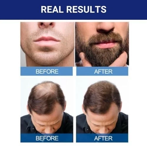 ✳️🔥Kirkland Hair Regrowth Treatment 5% Minoxidil Foam for Men - 6 Months Supply - Image 2 of 4