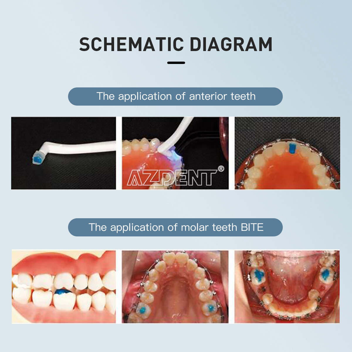 DENTEX Dental Orthodontic Adhesive Kit /Mini/NoMix Bonding/Light Cure