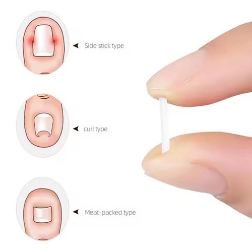 Corrector de uñas almohadilla de uñas encarnada ranura herramienta para el cuidado de los pies corrector de uñas de los pies 50 un. - Imagen 14 de 16