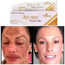 Wheezal Mel X Melasma Cream - Natural Treatment for Skin Pigmentation