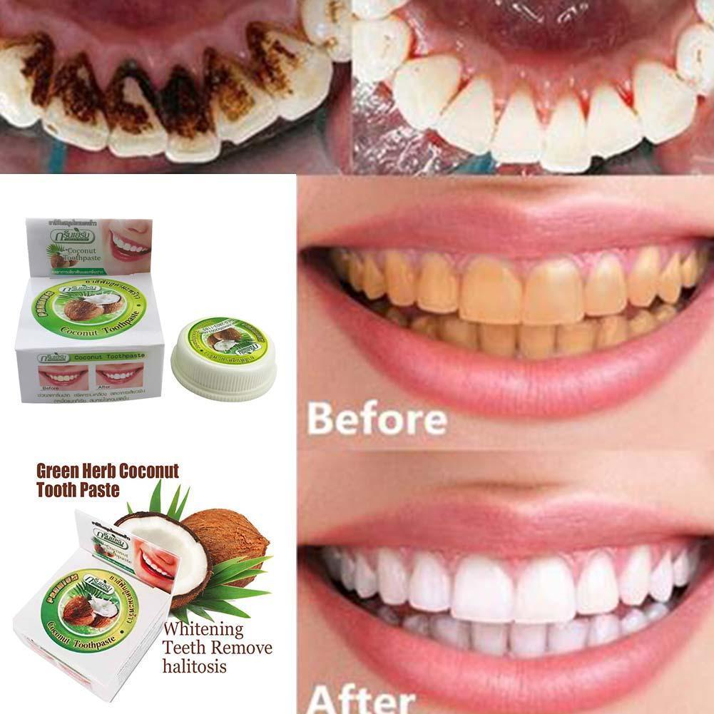 Turmeric And Coconut Oil Teeth Before And After Coconut Oil Before And After Teeth